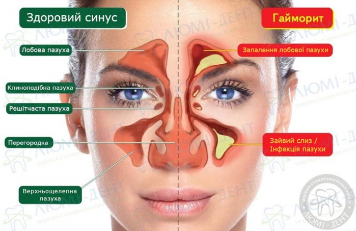 гайморит ознаки фото ЛюміДент