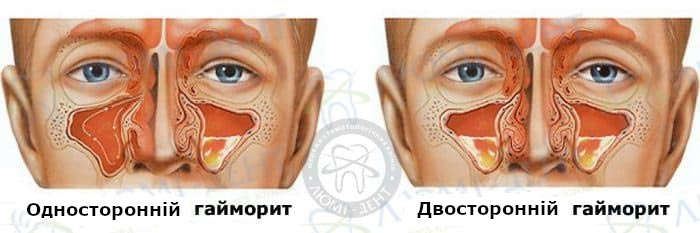 Як зрозуміти що гайморит одонтогенний?