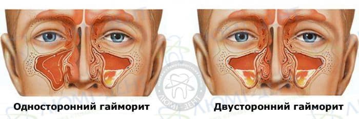 гайморит симптомы фото ЛюмиДент