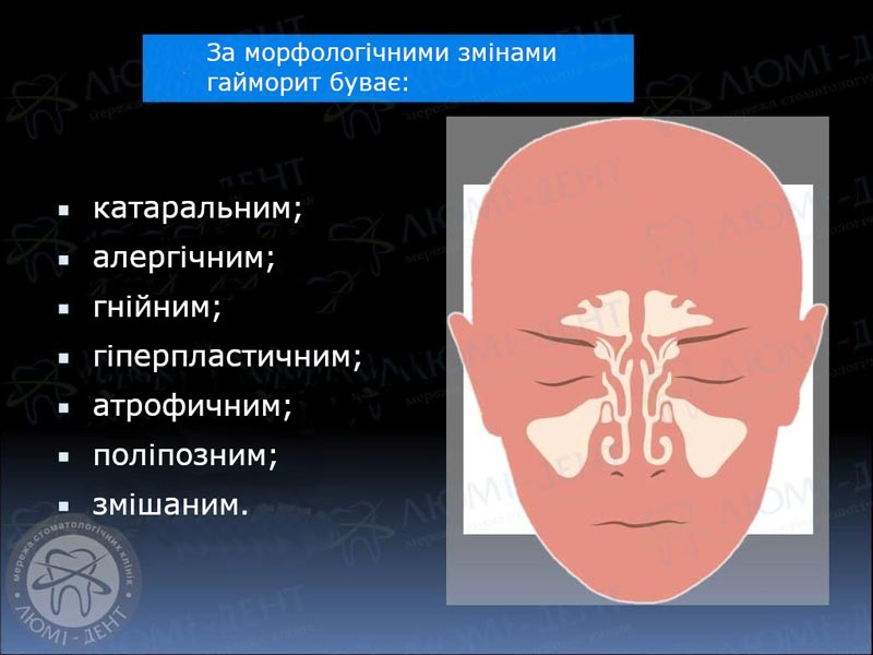 Признаки на рентгенограмах при гаймориті одонтогенному