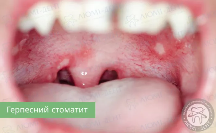 Приклад герпесного стоматиту герпесний стоматит фото ЛюміДент
