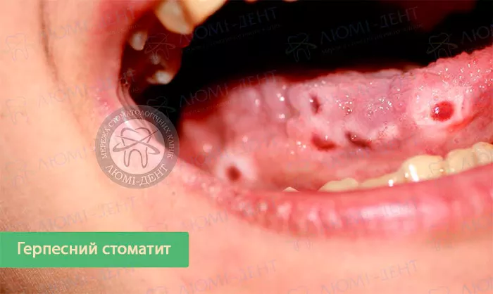Приклад герпесного стоматиту герпетичний стоматит фото ЛюміДент