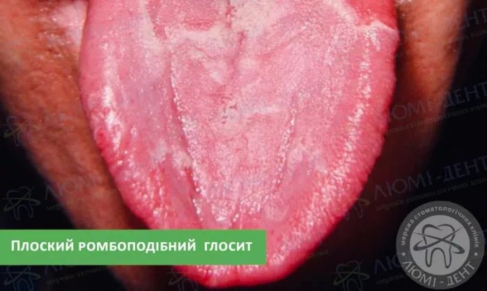 Плоске ромбоподібне запалення язика глосит язика фото ЛюміДент