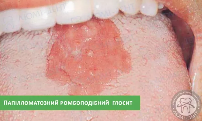 Папілломатозне ромбоподібне запалення язика гунтеровський глосит фото ЛюміДент