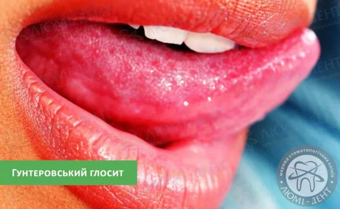 Гунтеровське запалення язика як лікувати глосит фото ЛюміДент