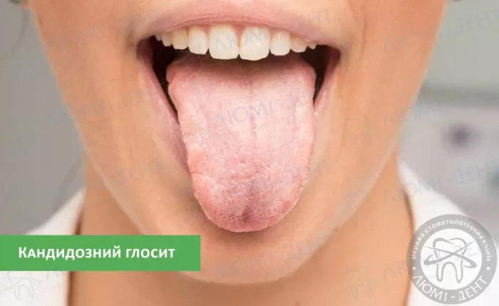 Кандидозне запалення язика кандидозний глосит фото ЛюміДент
