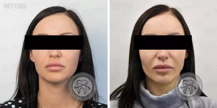 До і після видалення грудочок Біша Грудки Біша фото Люмі-Дент