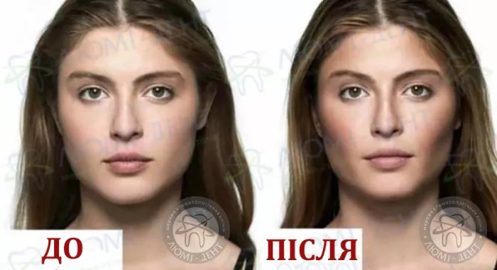 До після видалення грудок Біша Видалення грудок Біша фото Люмі-Дент