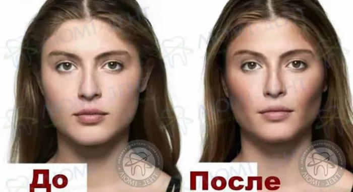До после удаления комков Биша Удаление комков Биша фото Люми-Дент