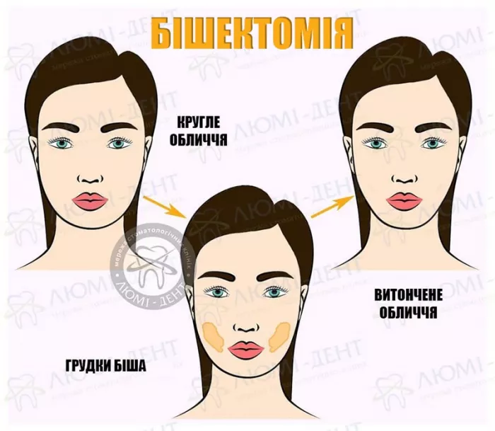 Видалення грудок Біша Грудочки Біша фото ЛюміДент
