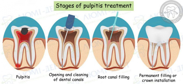 Dental treatment of teeth photo LumiDent