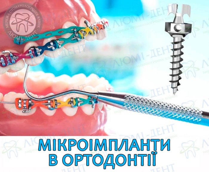 Мікроімплант в ортодонтії фото Люмі-Дент