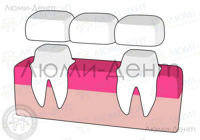 что такое несъемные зубные протезы фото ЛюмиДент