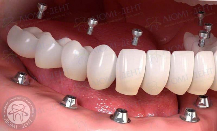 несъемное протезирование зубов это фото ЛюмиДент