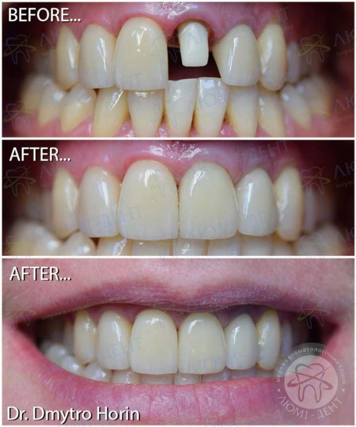 несъемное протезирование зубов фото ЛюмиДент