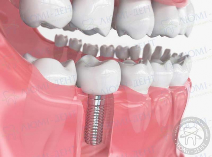 незнімне протезування зубів види фото ЛюміДент