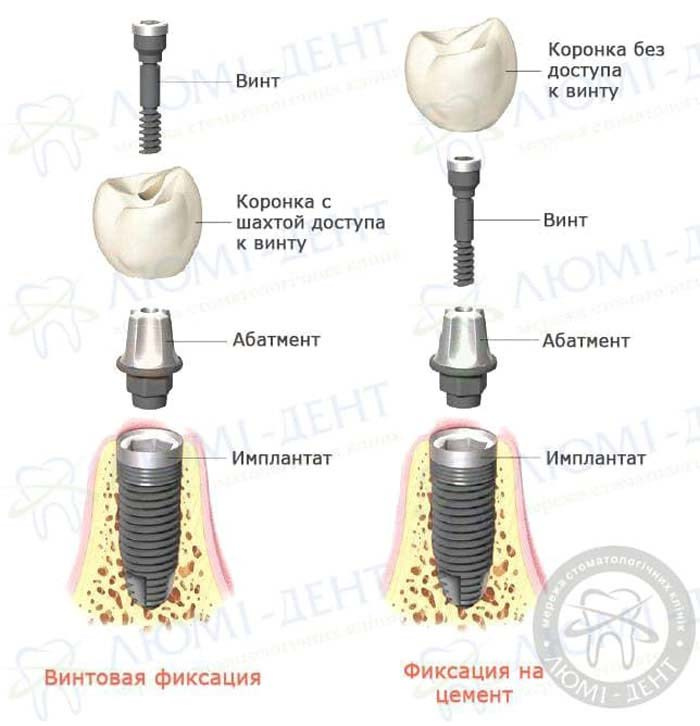 несъемные зубные протезы это фото ЛюмиДент