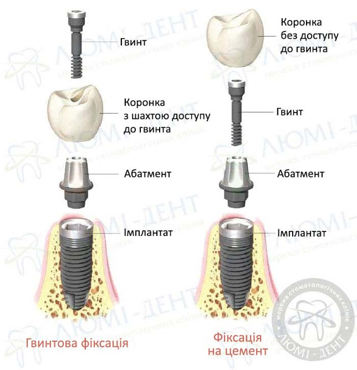 незнімні зубні протези це фото ЛюміДент