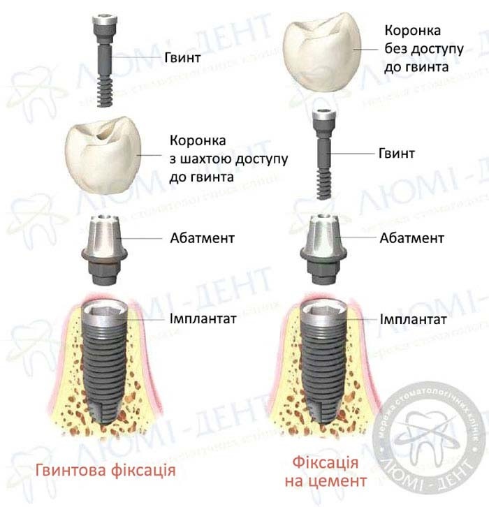 Види фіксації протезів Незнімні зубні протези це фото Люмі-Дент