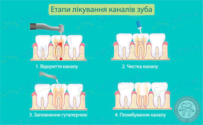 Методи пломбування кореневих каналів фото ЛюміДент