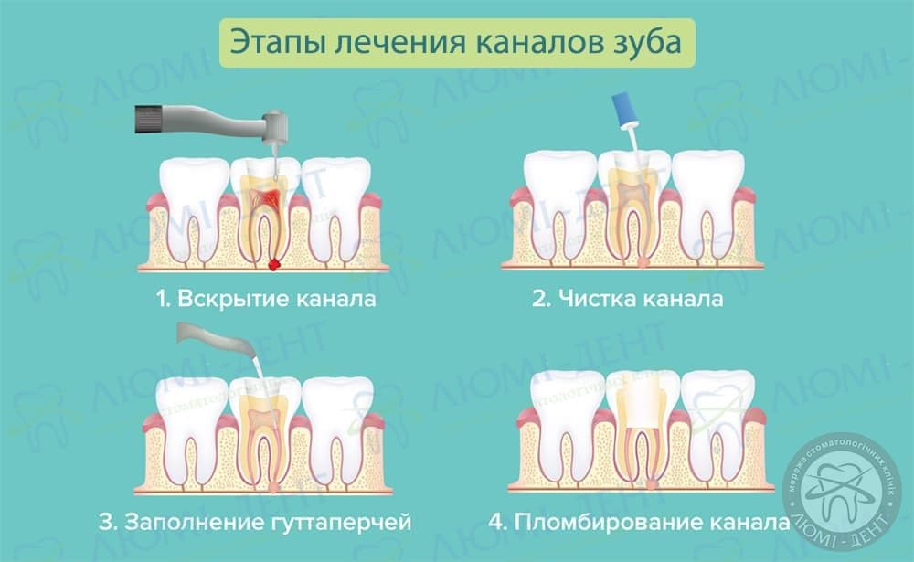 Методы пломбирования корневых каналов фото ЛюмиДент