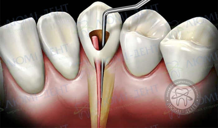 Пломбирование канала зуба фото ЛюмиДент