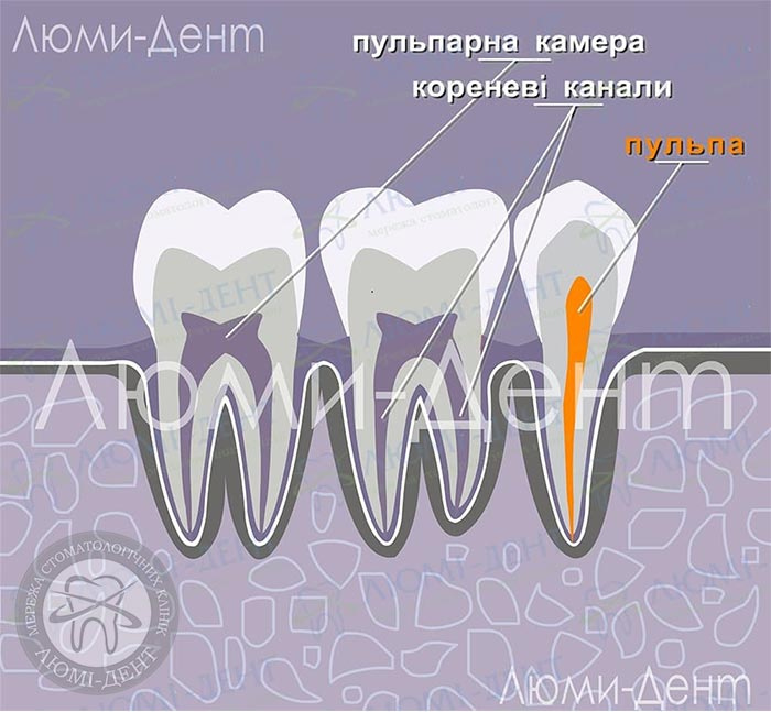 Пломбування каналів зуба фото ЛюміДент
