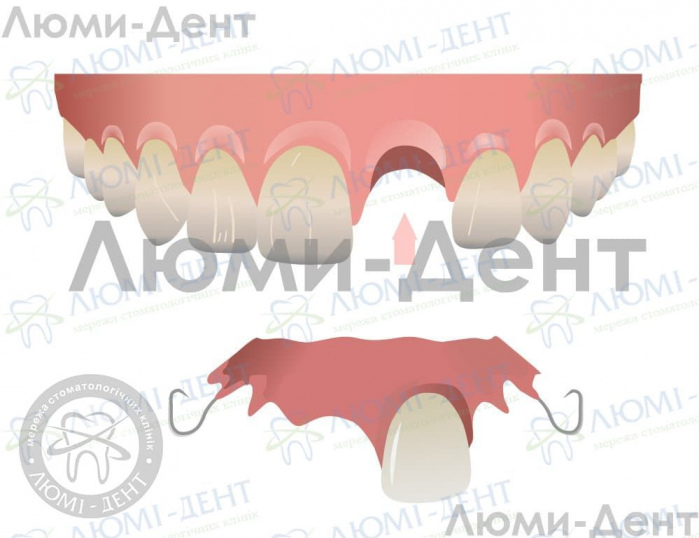 Полная потеря зубов фото ЛюмиДент