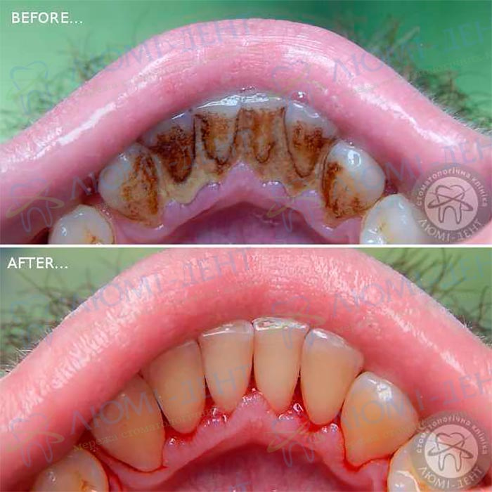 профессиональная чистка зубов до и после фото ЛюмиДент