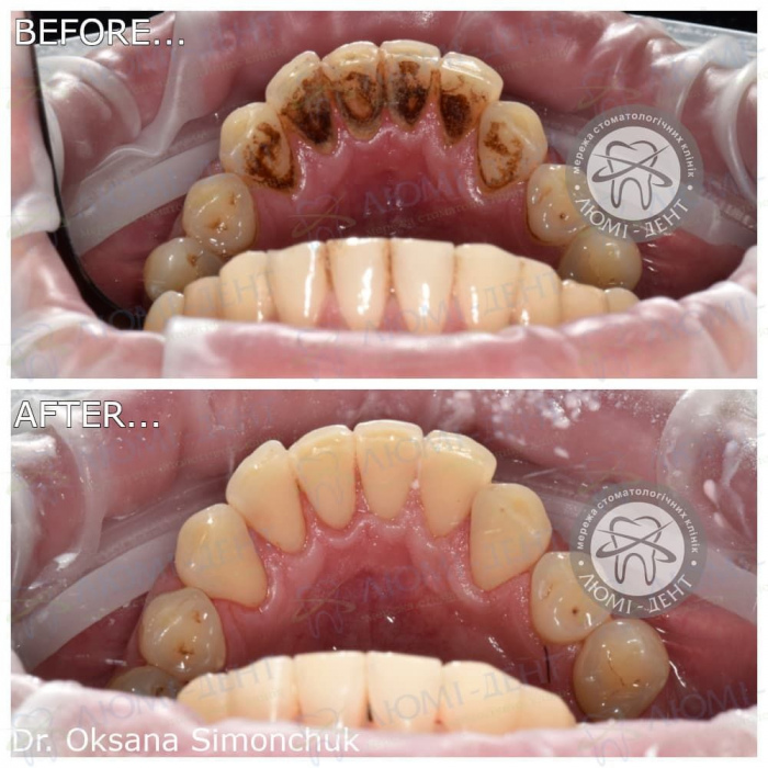 professional teeth cleaning photo stages LumiDent