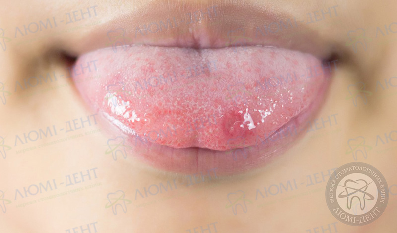 Незвичайні причини появи прищів на язиці