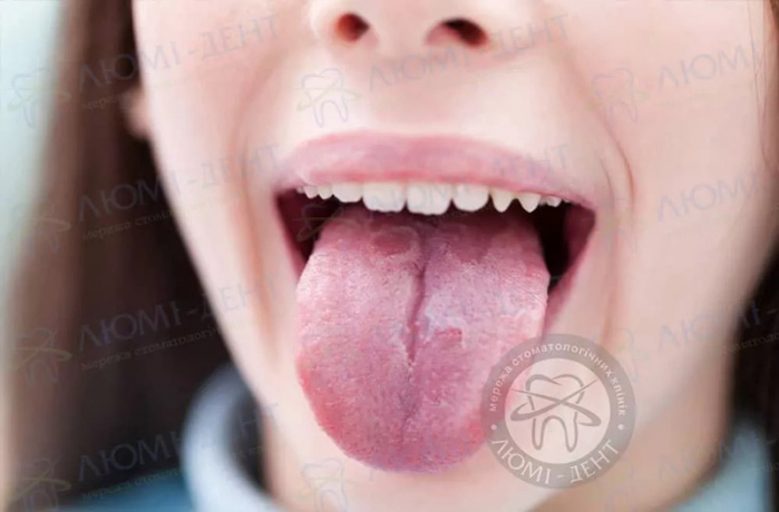 Болячка на корені язика фото ЛюміДент