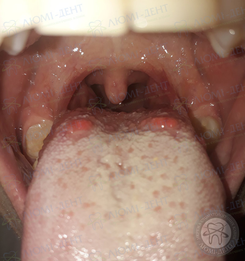 Папилломы в горле – лечение папилломатоза гортани