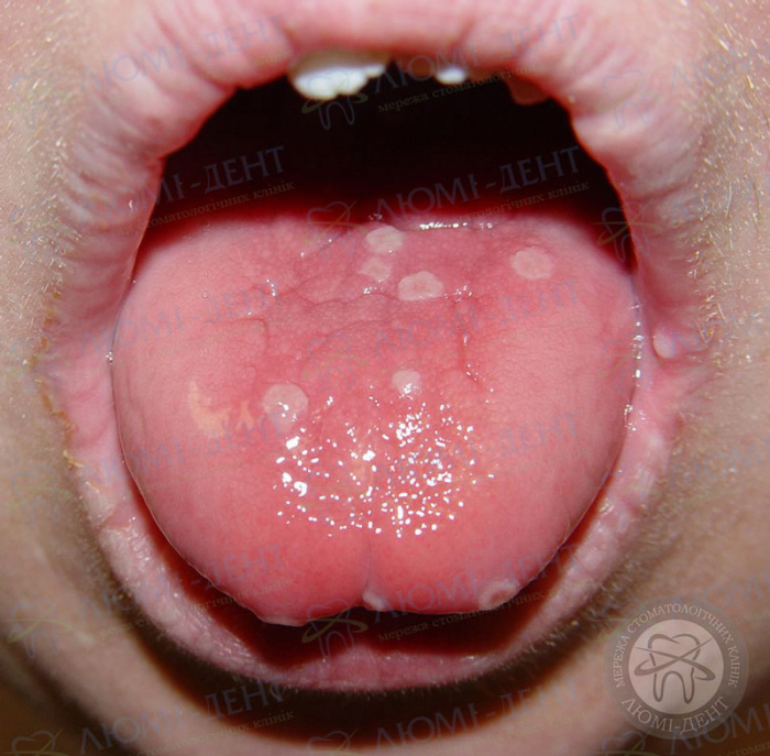 Сыпь на корне языка фото ЛюмиДент