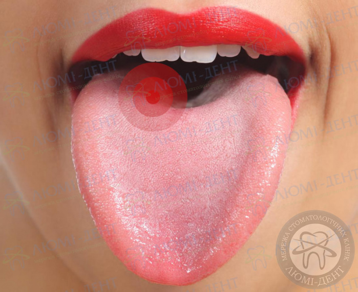 Сыпь на корне языка фото ЛюмиДент