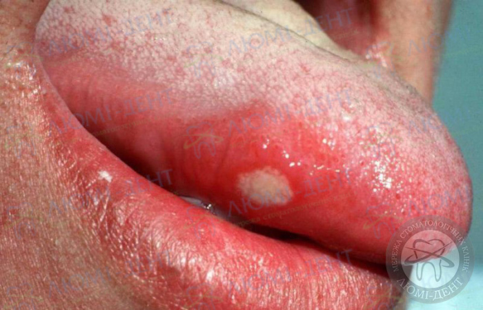 Воспаление на корне языка фото ЛюмиДент