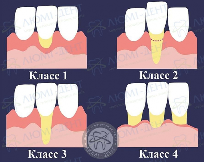 Рецессия десен фото ЛюмиДент