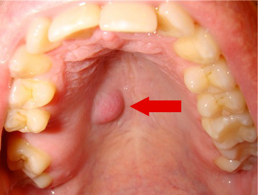 Шишка На Губе Небе Во Рту 9 Фото Опухоль ЛюмиДент
