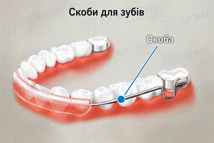 Конструкція ортодонтичної скоби скоби на зуби фото ЛюміДент