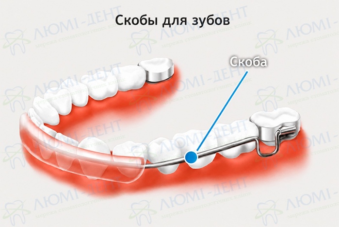 Конструкция ортодонтической скобы скобы для зубов фото ЛюмиДент