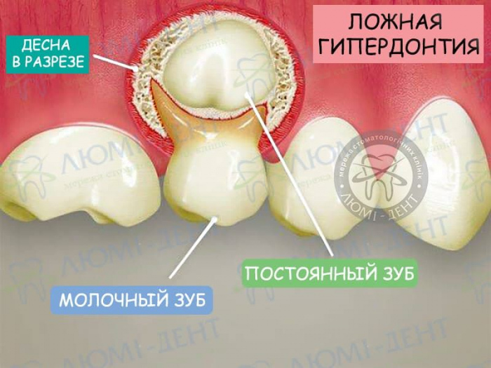 Второй ряд зубов фото ЛюмиДент