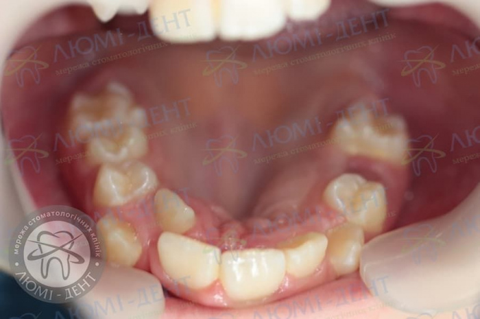 Зуби на піднебінні фото ЛюміДент