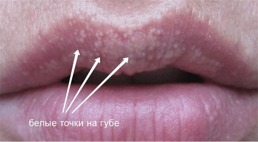 Белая сыпь во на губе фото Люмидент