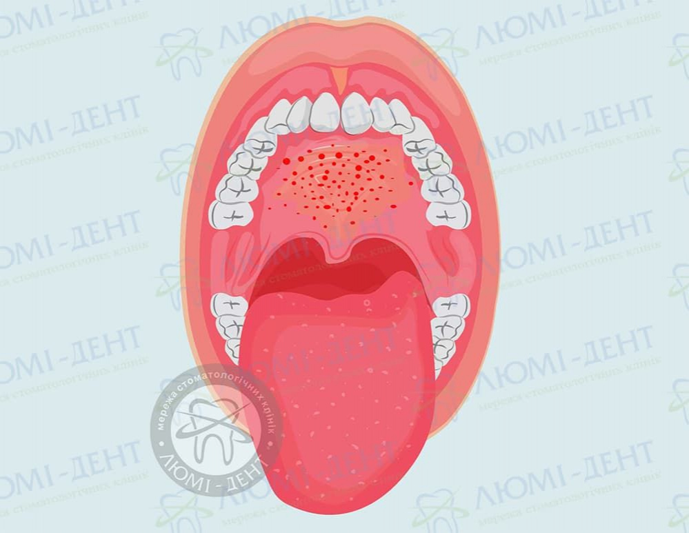 Тривалість використання Мірамістину в роті