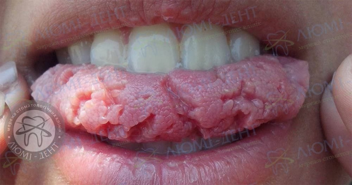Тріщина на язиці причини фото ЛюміДент