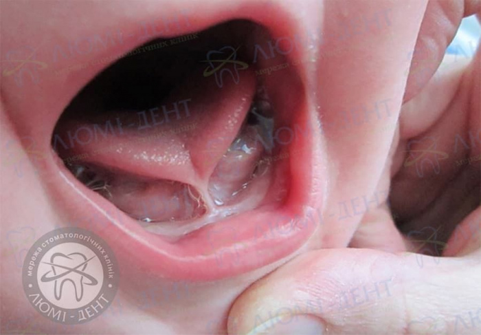 Підрізання вуздечки язика фото ЛюміДент