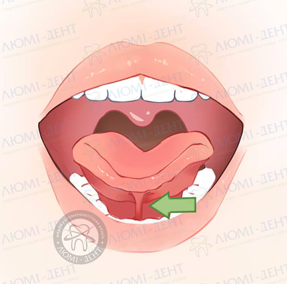 Уздечка под языком болит: причины и способы лечения