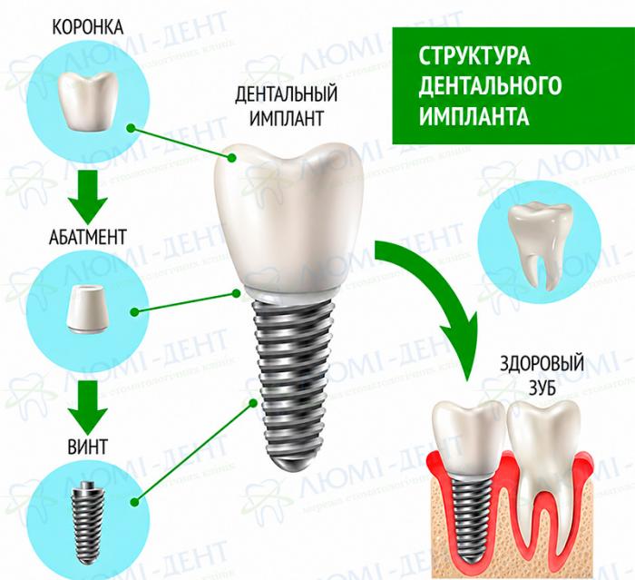 Схема коронки на имплантате зуба — Люми-Дент Схема коронки на имплантате зуба — Люми-Дент