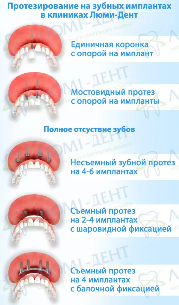 Протезирование на зубных имплантах в клиниках Люми-Дент коронки на импланты виды фото ЛюмиДент
