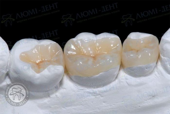 Какие бывают пломбы на зубы фото ЛюмиДент